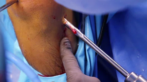 CLOSE UP. Surgeon using a drill during operation Stock-Footage 45824660