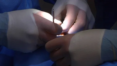 Close-up of surgeon's hands in actual operation Stock Footage 99425363