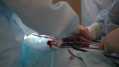 Close up of surgeon's hands in the blood doing surgery on the uterus Stock Footage 70809821