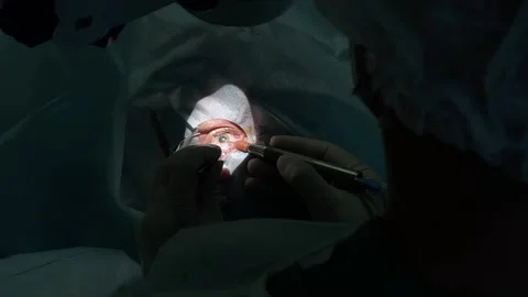 Close-up of surgeon's hands during an ophthalmic eye operation. Eye Surgery. Video stock 155456164