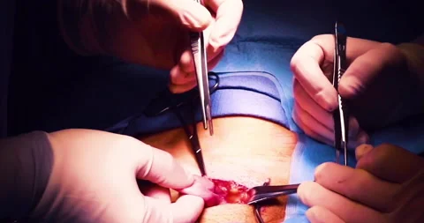 Close up of surgeons hands operating on a patient hernia Stock Footage 146614404