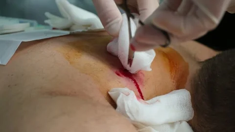 Close-up of a surgeon's hands in sterile gloves performing a minor surgical Vídeo Stock 337723396