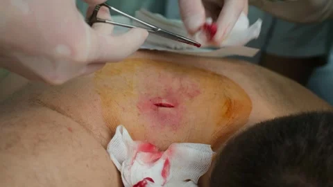 Close-up of a surgeon's hands in sterile gloves performing a minor surgical 스톡 동영상 337723446