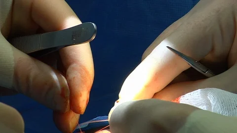Close-up of a surgeons hands stitching a patient on an operating table. Stock Footage 99460443
