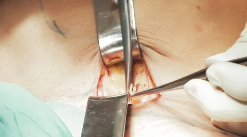 Close up surgeon's hands stretching and exposing a vein Stock-Footage 67281107