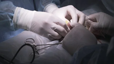 Close up of surgeons making procedure of the foreskin circumcision. Action Stock Footage 141161892