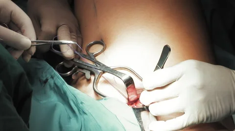 Close up surgeons suture a vein Stock Footage 67283186