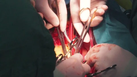 Close-up of a surgery Stock Footage 72927310