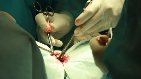 Close up of surgery team operating Stock Footage 86597940