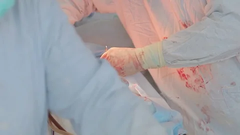 Close up of surgerys hands team operating. 库存影片 80967788