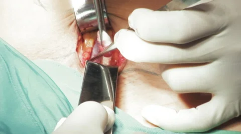Close up surgical gloves and instruments Stock Footage 67282127