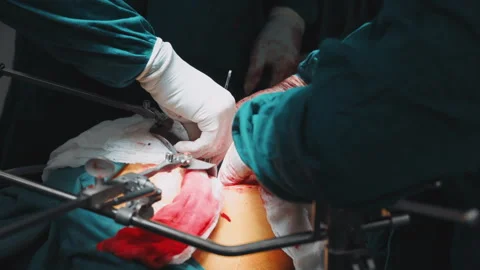 Close-up of a surgical procedure in an operating room, showing surgeons hands Stock Footage 328305240