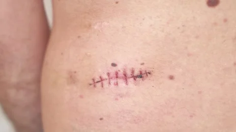 Close up of a surgical wound with stitches on human skin healing slowly ove.. Stock Footage 339768892