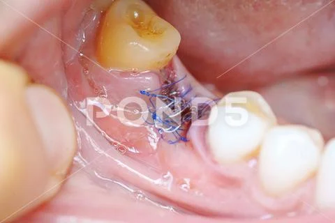Photograph: Close-up. a sutured socket in the oral cavity after tooth ...