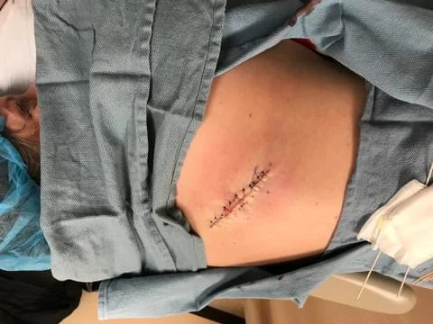 Close up of sutures after operation on back Stock Photos