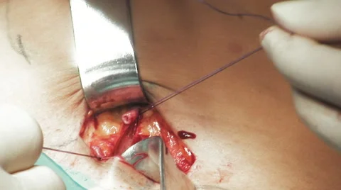 Close up suturing a vein Stock-Footage 67283527