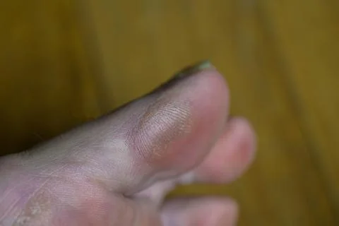 Close-up of a swollen, reddened toe Stock Photos