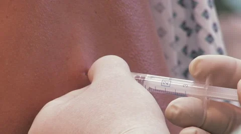Close up syringe needle and spinal anesthesia Stock-Footage 67277762