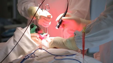 Close-up. A team of surgeons perform a surgical procedure to remove a cancer Stock Footage 94020894