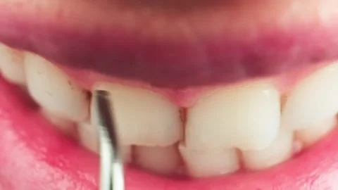 Close-up of teeth cleaning and calculus removal using an electric tool Stock Footage 278547394