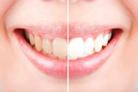 Close-up teeth female between before and after brush the teeth, selective foc Stock Photos