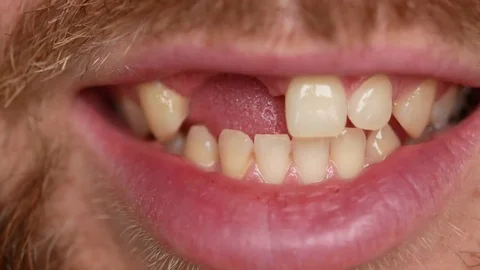 Close-up of teeth. A man shows his denture on two teeth. There are not enough Stock Footage 81990313