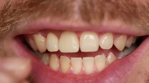 Close-up of teeth. A man shows his denture on two teeth. There are not enough Stock Footage 82184462