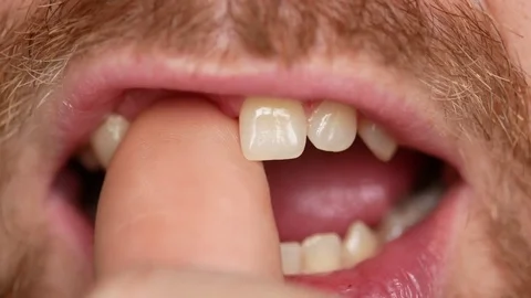 Close-up of teeth. A man shows his denture on two teeth. Stock Footage 83399160