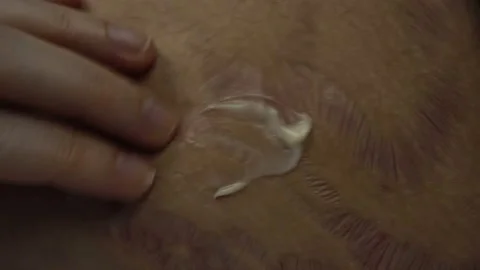 Close Up of terrible skin scars. Marks from a bad accident, surgery, or from hor Stock Footage 142504469