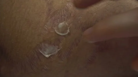 Close Up of terrible skin scars. Marks from bad accident, surgery or from horrib Stock Footage 142506396
