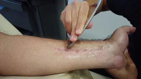 Close Up Therapist using IASTM instrument to treat scapular pain. Video stock 249746776