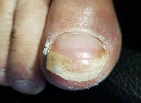 Close up of a toe with long nail needing a pedicure Stock Photos