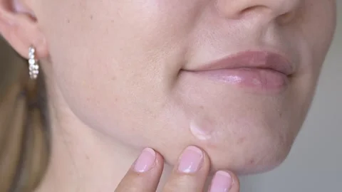Close-up of transparent acne patch covering inflamed blemish on female chin Video stock 336617389