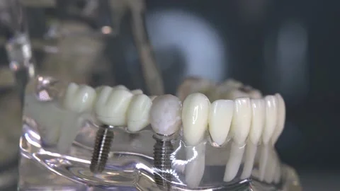 Close-up of the transparent model of human jaw with implants. Video stock 201172355
