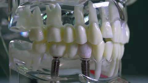 Close-up of the transparent model of human jaw with implants. Stock Footage 201172546