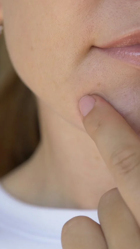 Close-up of transparent pimple patch covering acne spot on female chin. Beauty Stock Footage 336405922