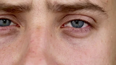 Close up of two annoyed red blood eyes of male affected by conjunctivitis or aft Stock Footage 91987121