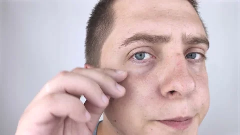 Close up of two annoyed red blood eyes of male affected by conjunctivitis or aft Stock Footage 135213971