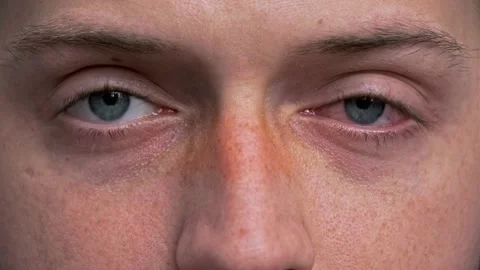 Close up of two annoyed red blood blue eyes of male affected by conjunctiviti 스톡 동영상 149596587