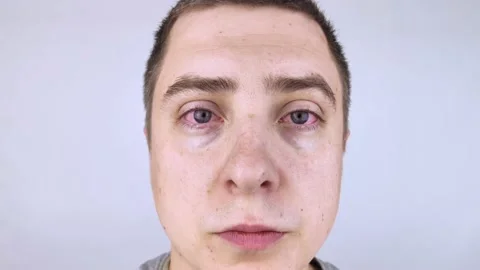 Close up of two annoyed red blood eyes of male affected by conjunctivitis or aft Stock Footage 155406724