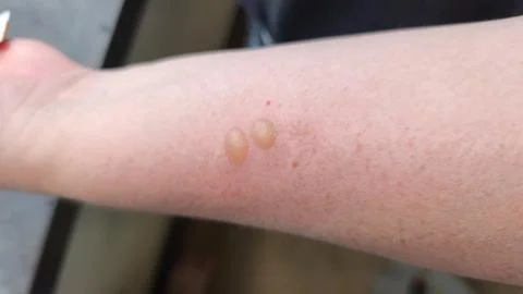 Close-up of two fluid-filled blisters on a human forearm. Stock Photos