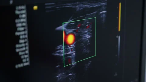 Close-Up of Ultrasound Screen Displaying Thyroid Gland Examination 動画素材 296782665