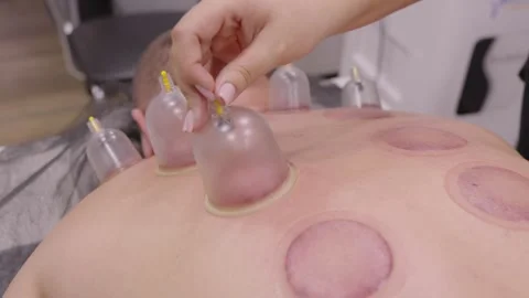 Close up of vacuum cupping therapy on a man's back Stock Footage 331460978