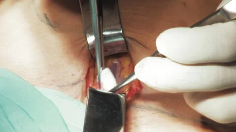Close up Vein surgery Stock-Footage 67282262