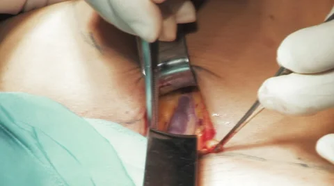 Close up vein surgery Stock Footage 67285846