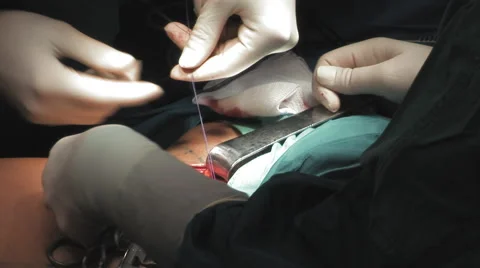 Close up vein surgery Stock Footage 67286626