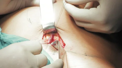 Close up vein suture Stock Footage 67283334