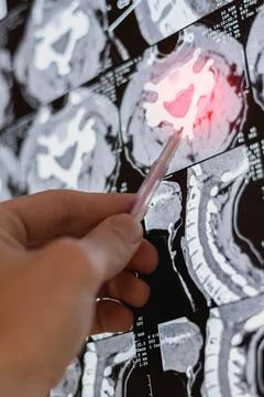 Close up vertical image, doctor learning MRI or X-ray of curvature vertebra.. Stock Photos