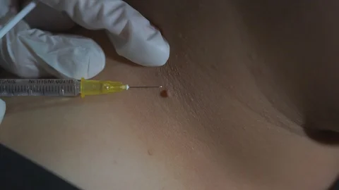 Close up video, Surgeon injecting local anesthetic around the mole Stock Footage 118076475