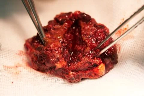 Close-up view of abnormal vascular in the brain causing seizure. Stock Photos